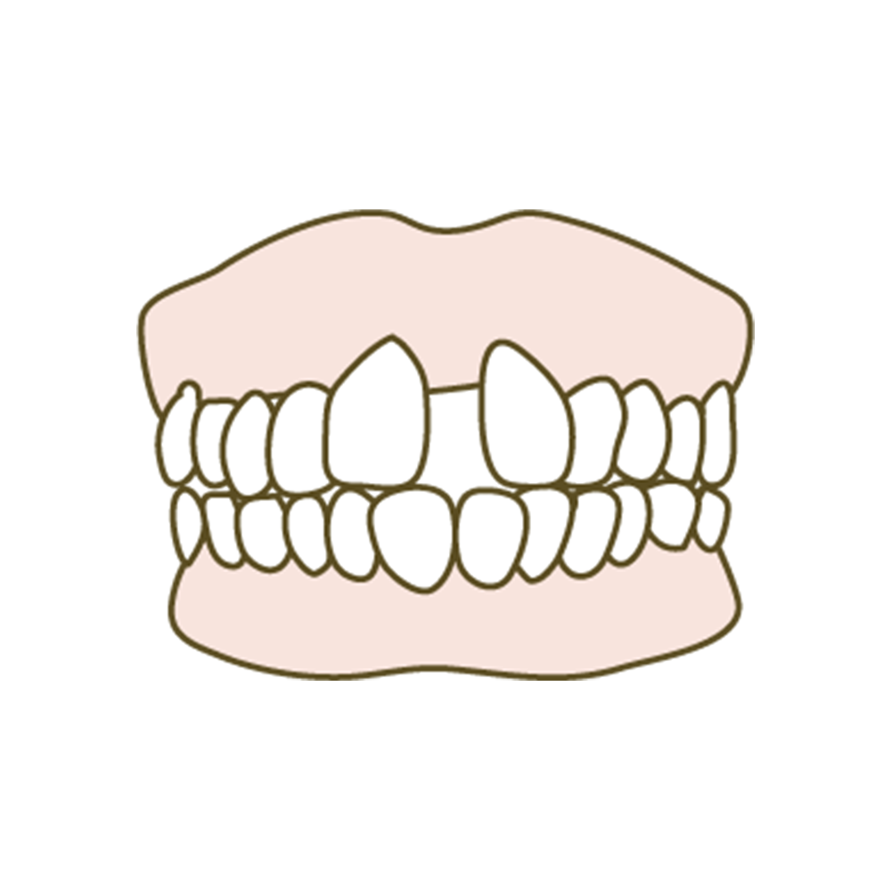 Gapped Teeth